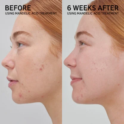 The INKEY List Mandelic Acid Treatment - Imagen 6