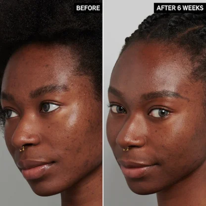 The INKEY List Tranexamic Acid Hyperpigmentation Treatment - Imagen 4