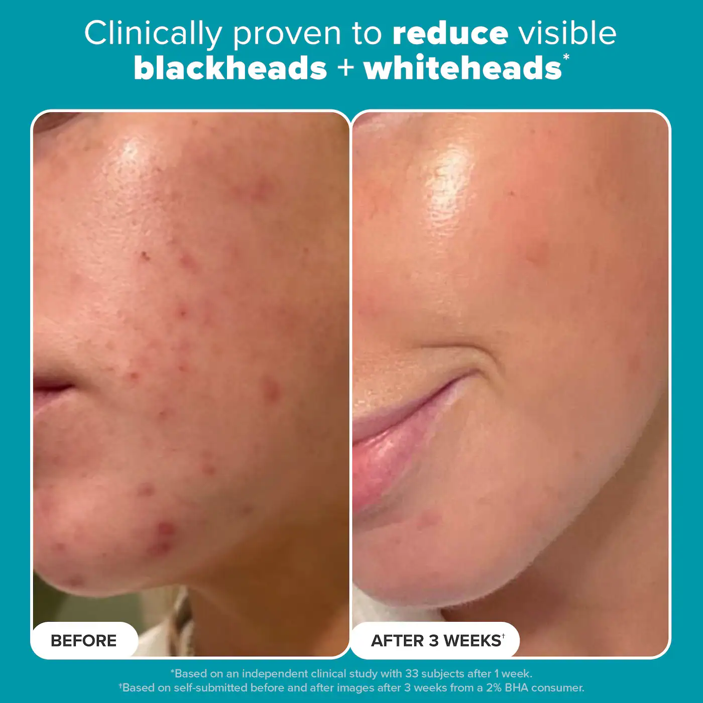 Paula's Choice Skin Perfecting 2% BHA Liquid Exfoliant - Imagen 11