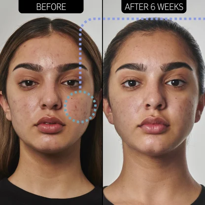 The INKEY List ACNE SOLUTION 5% BENZOYL PEROXIDE CLEANSER - Imagen 3