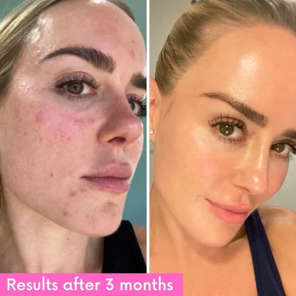KOA LIFE Niacinamide Booster - Imagen 2