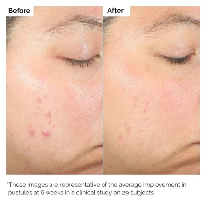 The Ordinary Salicylic Acid 2% - Imagen 2