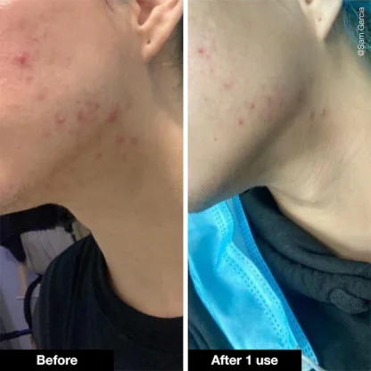 iNNBEAUTY PROJECT Pimple Paste Overnight Blemish Spot Treatment - Imagen 7
