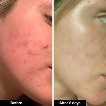 iNNBEAUTY PROJECT Pimple Paste Overnight Blemish Spot Treatment - Imagen 5